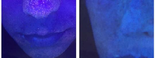 Skinscanner huidanalyse